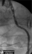 Ureteritis Cystica